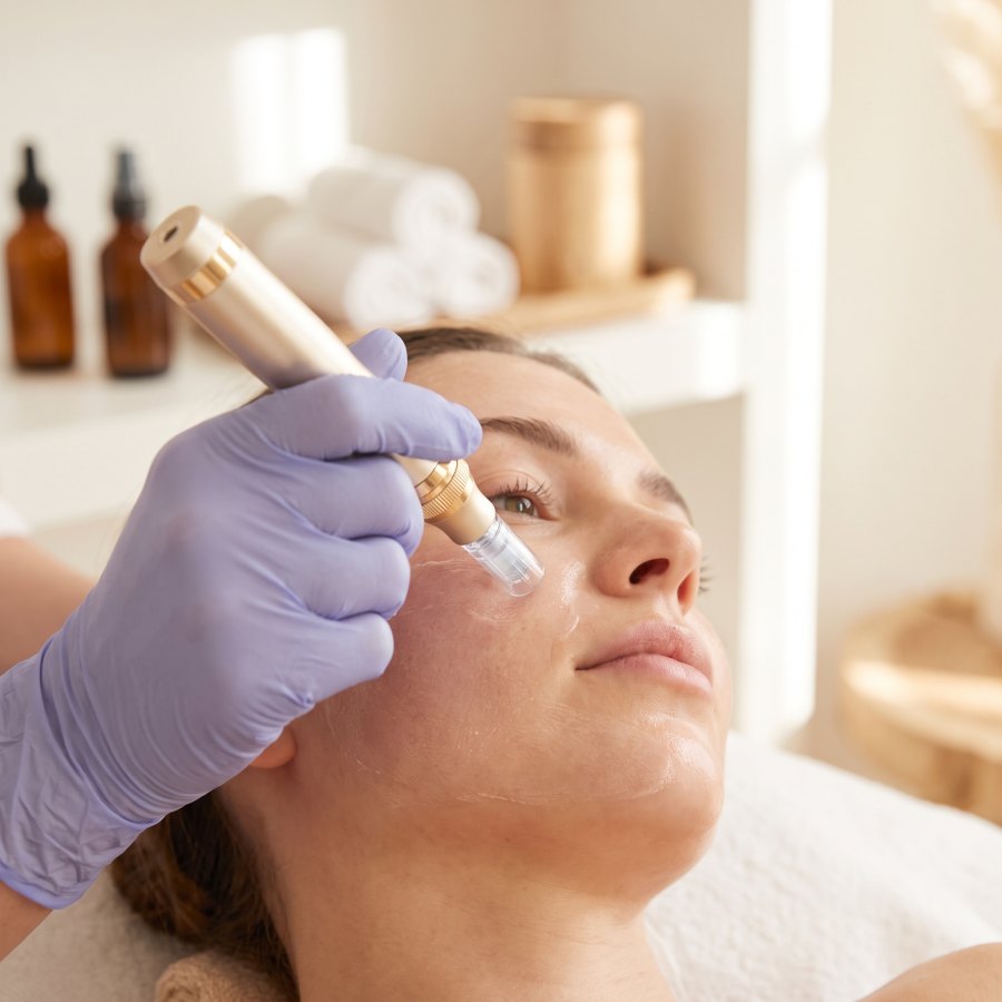 Microneedling-Behandlung bei Höfler Finest