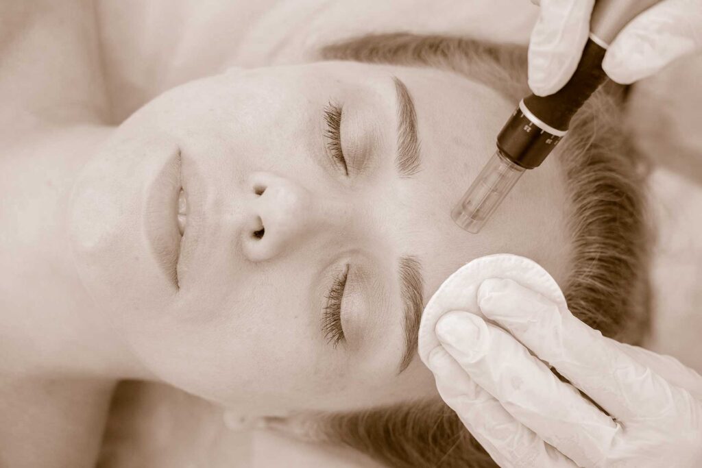 Microneedling-Behandlung bei Hoefler Finest